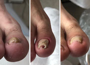 Nagelbeugel